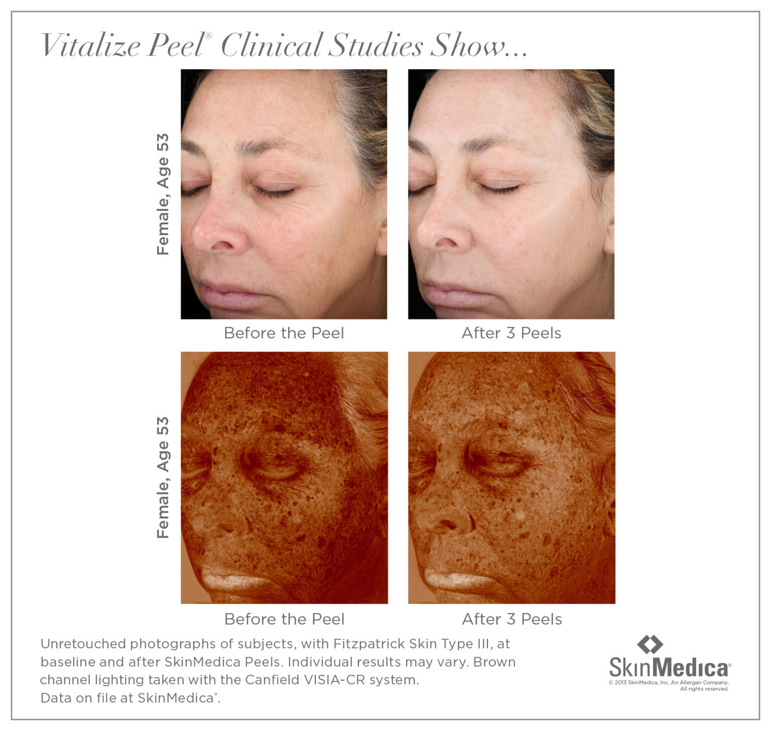 Chemical Peels | Pure Med Spa | Bay City, Saginaw, Midland